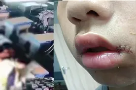 湖南娄底一初中生被同学打伤嘴角缝针 校长：双方家长已协商视频封面