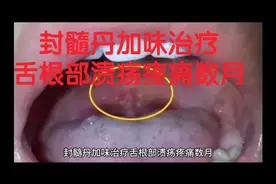 封髓丹加味治疗舌根部溃疡疼痛数月视频封面