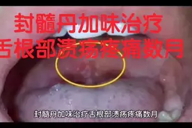 封髓丹加味治疗舌根部溃疡疼痛数月视频封面