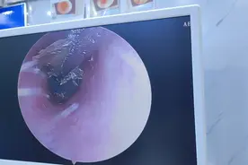 外耳道起干皮，又是一大片大片的视频封面