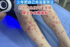少年把自己关浴室哭泣，妈妈焦急撞开门傻眼，腿上牛皮癣紧贴