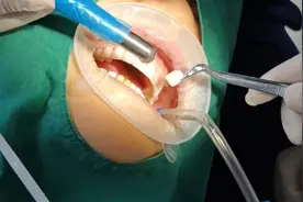 激光拆除全瓷贴面，高效快捷舒适无感，全口16颗半小时搞定！