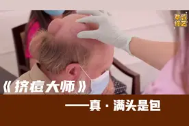 挤痘大师—真·满头是包，看李医生一招化解