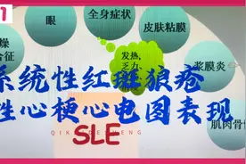 系统性红斑狼疮患者急性心梗心电图表现视频封面