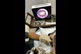 耳朵里生了蜱虫，看医生怎么操作视频封面