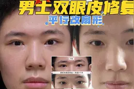 男生双眼皮修复模版参考，平行改扇形|眼部整形及修复潘贰博士案视频封面