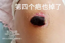 车祸摔伤右腿后第二十五天——记录膝盖上第四个疤掉的全过程。视频封面