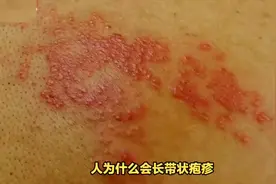 人为什么会得带状疱疹？