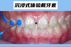 牙缝大戴牙套全过程，戴耳机看超解压！