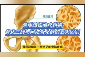 骨质疏松治疗药物骨化三醇与阿法骨化醇的五大区别