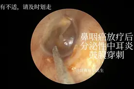 鼻咽癌放疗后分泌性中耳炎鼓膜穿刺视频封面