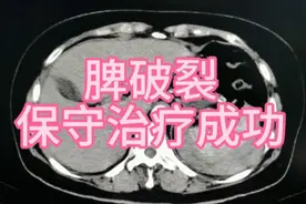 脾破裂CT影像表现！这个病人比较幸运，经过保守治疗保住了脾脏！视频封面