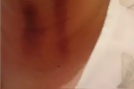 揪脖子痧。视频封面