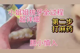 超详细的拔牙根过程，不熟悉拔牙过程的可以来。