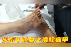 足疗修脚店灰指甲修复过程之病甲清除，一起来看看吧视频封面