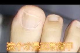 如何避免得甲沟炎养成正确修剪脚指甲的好习惯要平剪指甲不要深挖
