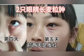 姐姐2只眼睛长麦粒肿，没去医院，涂了2种药就好了，脓不能用手挤