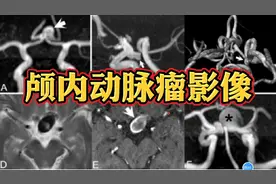 几例典型颅内动脉瘤MR影像表现分享，建议收藏！视频封面