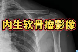 肱骨内生软骨瘤影像表现，放射科医生讲解！视频封面