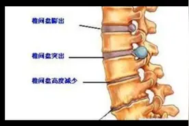 腰部疾病知识视频封面