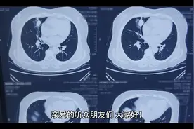 29岁女子体检发现右肺上叶有结节，医生诊断极可能是肺部恶性肿瘤视频封面