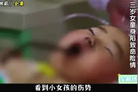 3岁女童被钢筋贯穿大脑，医生多次进行手术，最终挺过感染关视频封面