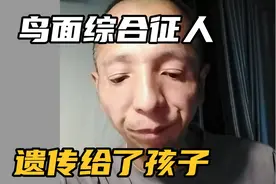 横店演员阿凡达是鸟面综合征人，孩子也被遗传到
