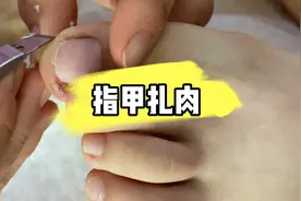 剪指甲没剪好，指甲扎肉了。视频封面