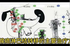 胰腺癌淋巴结转移还有治疗办法吗？视频封面