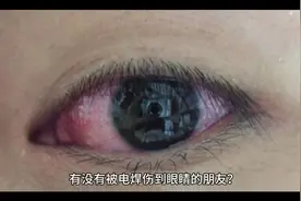 母乳治电焊烧伤眼睛有奇效。视频封面