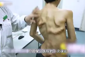 只因医院的一次误诊，导致男孩身上长满多余的骨头视频封面