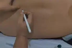 腰突针灸取穴教学视频封面