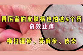 再厉害的皮肤病，也怕这4个药奇效止痒 横扫湿疹、荨麻疹、皮炎视频封面