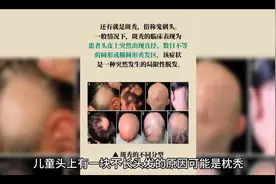 儿童头上突然有一块不想头发了，是什么原因呢视频封面