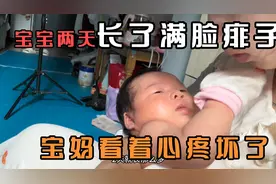 坐月子的第24天  宝宝长了满脸的痱子  宝妈用金银花水给宝宝洗脸