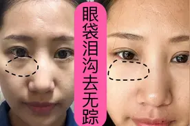 有眼袋别瞎治，点按4个黄金“消袋点”再严重的眼袋都消失视频封面
