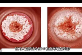 如何从宫颈涂片和HPV检查判断宫颈癌？视频封面