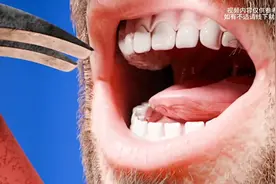 失去牙齿该怎么办？#创作者计划#科普知识