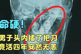 命硬！男子头里插了把刀，竟活四年安然无恙。#社会新闻视频封面