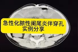 10岁小男孩夜间突发腹疼，一个全腹CT找到了原因视频封面