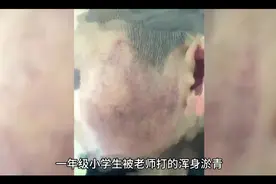 一年级小学生被老师打的浑身淤青，妈妈心疼痛哭视频封面