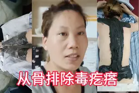 类风湿患者：全身起了一身毒疙瘩视频封面