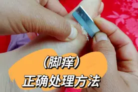 脚痒的厉害，涂药也不管用，试试我这个方法视频封面