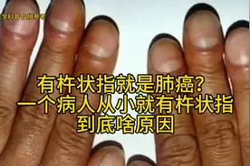 有杵状指就是肺癌？一个病人从小就有杵状指，到底啥原因视频封面