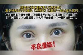 潘贰复杂双眼皮修复：做四项眼综合后睫毛外翻上睑退缩等怎么办？
