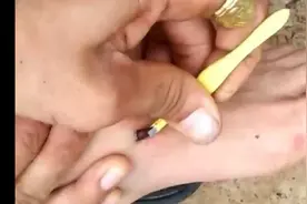 刺扎进肉里的时候因为疼痛肌肉会保护性收缩，所以拔刺会比较困难