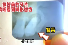 拔牙前从拍牙片中清晰的显现出畸形的阻生智齿，把邻牙吞噬掉破坏视频封面