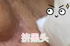 挤黑头/鼻子视频封面
