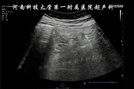 急性渗出性胰腺炎  阑尾扫查 #超声影像 #每天学习一点点 #胰腺炎 #脂肪肝 #阑尾炎 @抖音视频封面