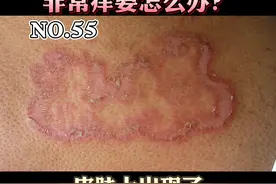 皮肤上出现了界限清楚的，环状、多环状红色斑片或斑块，非常的痒，#体癣 我们可以这么处理。#医学科普 #健康科普 视频封面